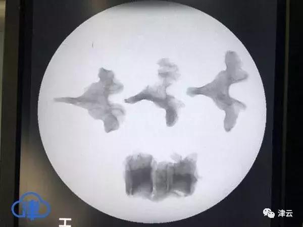 天津医院骨癌治疗_3D打印脊椎手术_天津术后护理体验