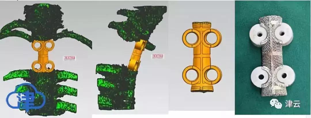 3D打印脊椎手术_天津医院骨癌治疗_天津术后护理体验