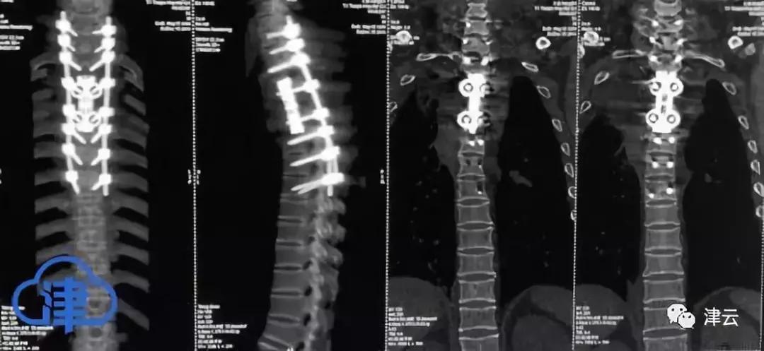 天津术后护理体验_3D打印脊椎手术_天津医院骨癌治疗