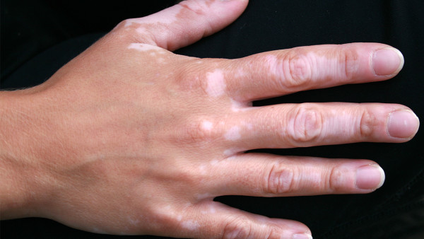 天津康复护理培训_天津哪里治白癜风好_天津治疗白癜风医院排名