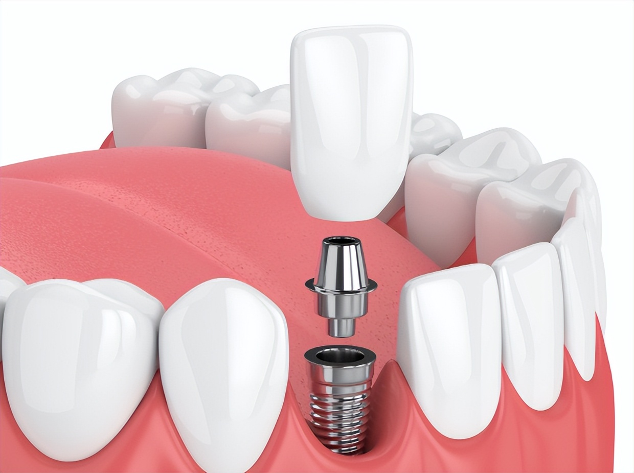 中老年人种植牙术后护理_天津术后护理新闻_种植牙风险