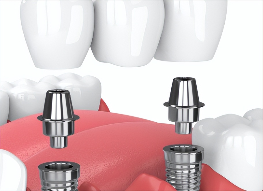 中老年人种植牙术后护理_种植牙风险_天津术后护理新闻